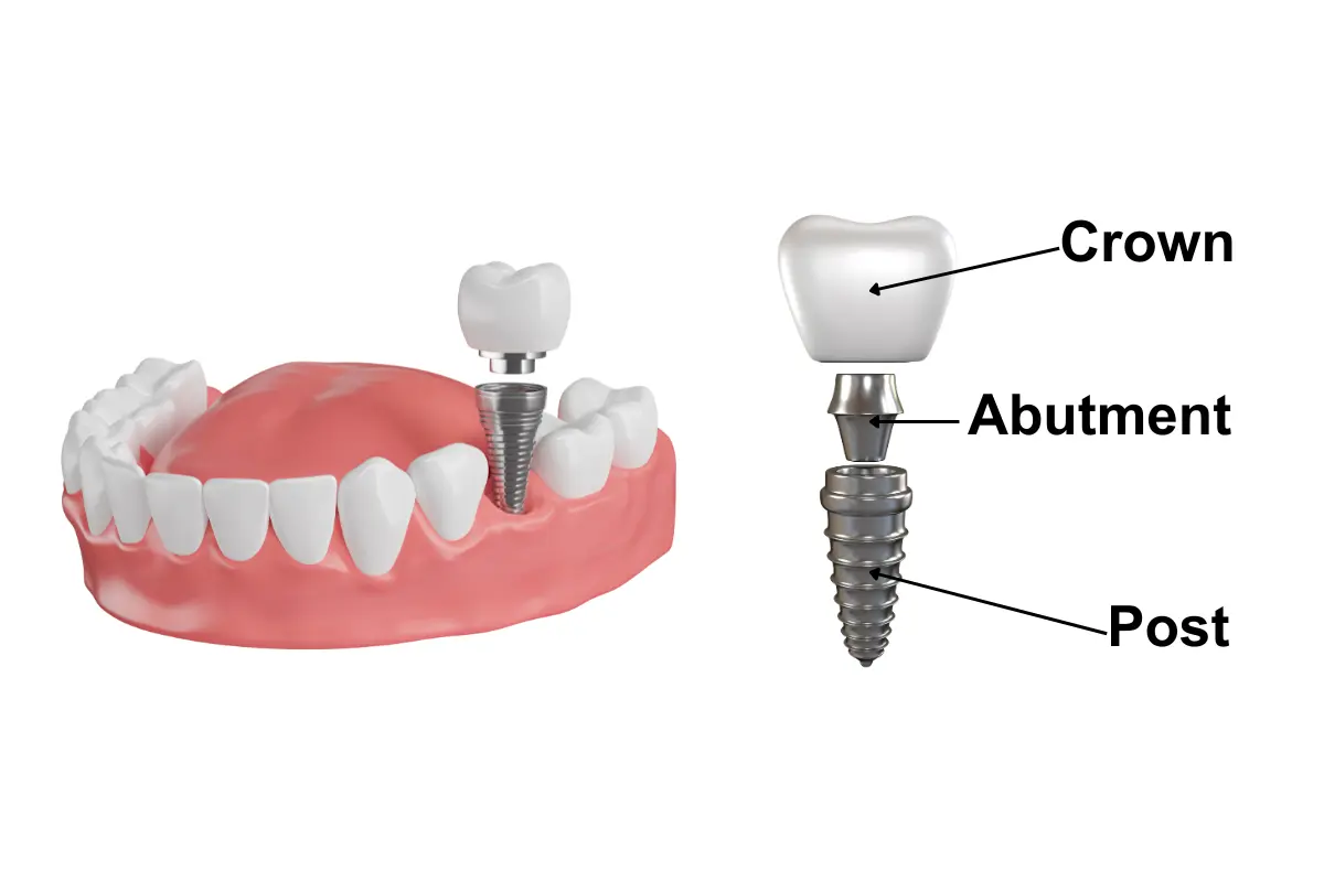 The image is a diagrammatic representation of a dental implant. It shows a 3D rendered tooth labelled as 'Crown' at the top, which is the part designed to resemble a natural tooth. Below the crown is the 'Abutment', which serves as a connector between the crown and the implant. At the bottom is the 'Post', also known as the implant, which is a threaded structure that is anchored into the jawbone. The diagram is for educational purposes, to explain the components and structure of a typical dental implant.